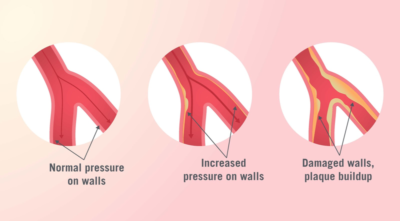 what-is-high-blood-pressure-teladoc-health-inc